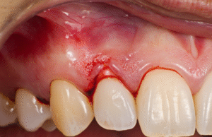How to Tell If You Have Gum Disease: 5 Warning Signs